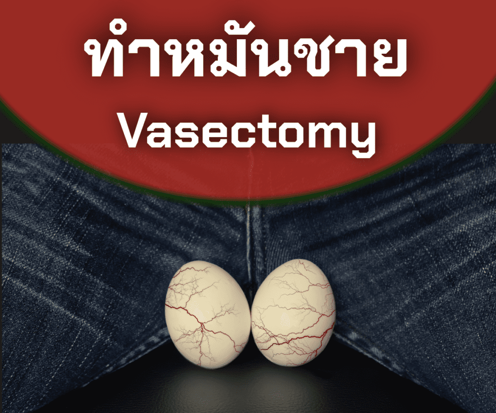 ทำหมันชาย